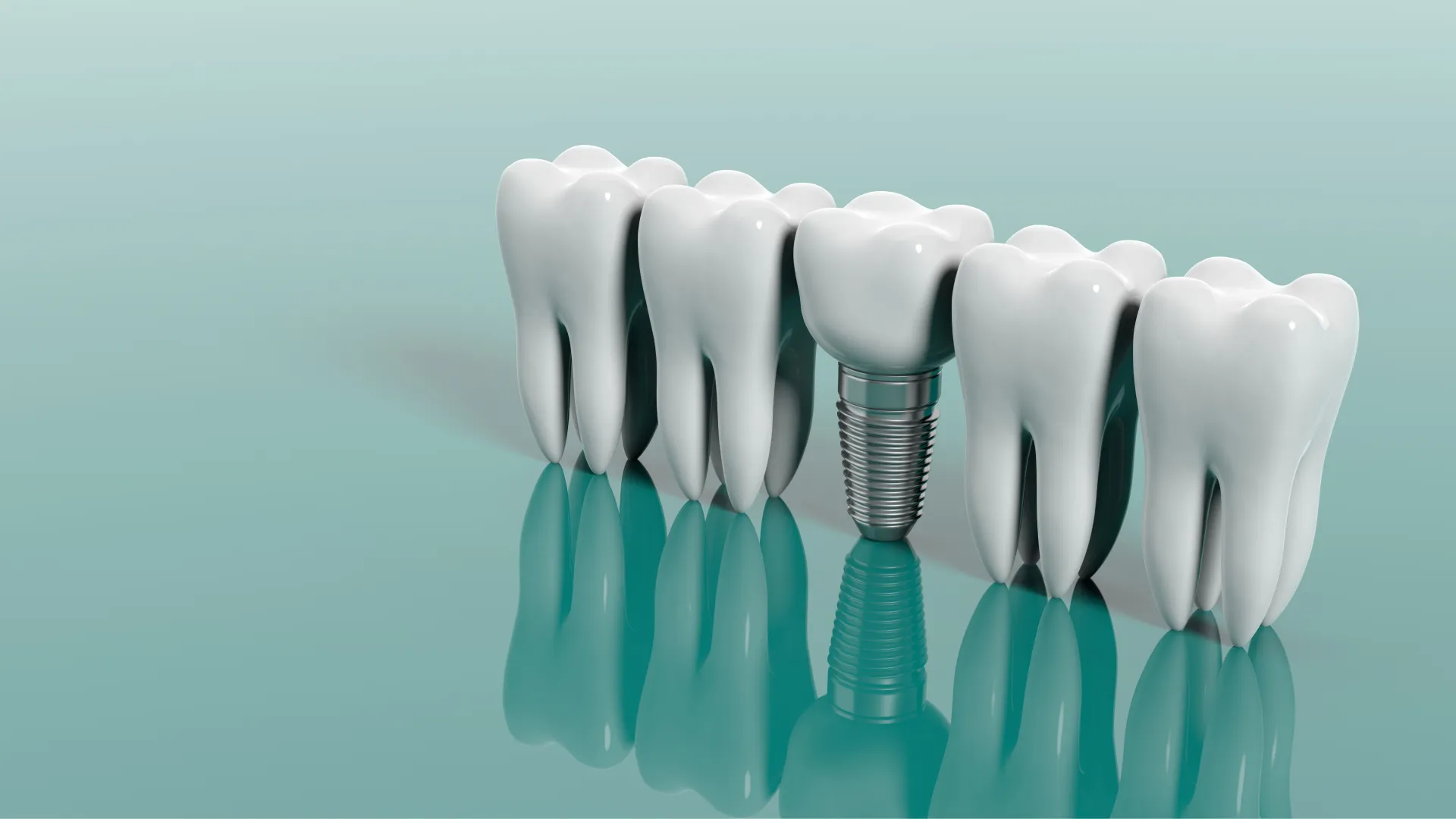 Dental Implant Clinic in India
